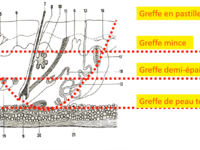 Greffes cutanées : généralités (Marc Revol)